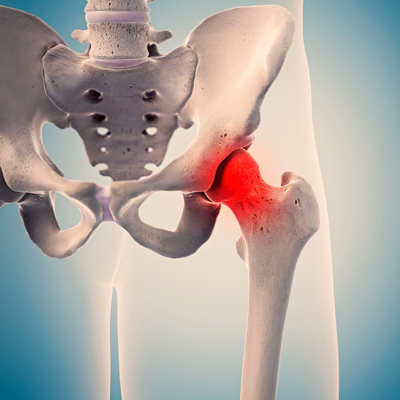 AVN Hip joint Diagnosis